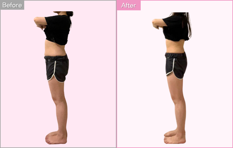 IEDEMOダイエット実施後の写真