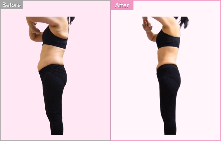 IEDEMOダイエット実施後の写真