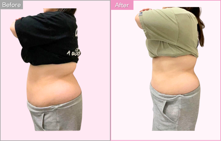 IEDEMOダイエット実施後の写真